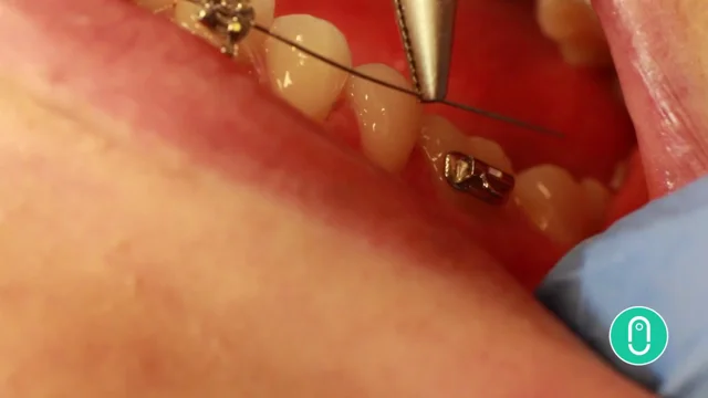 Poking wire - orthodontic emergency. on Vimeo
