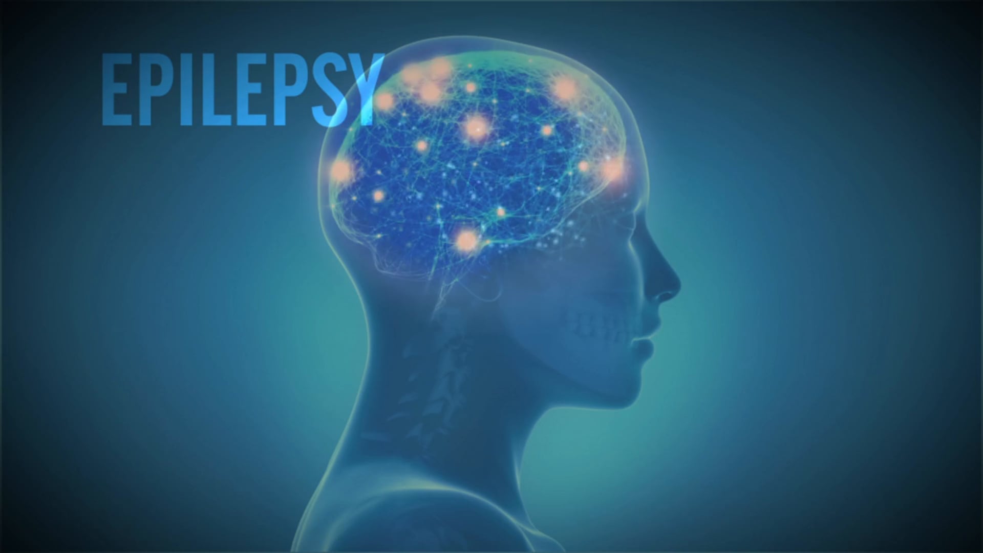 Epilepsy