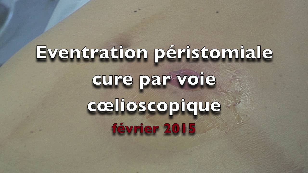 Cure d'éventration péristomiale on Vimeo