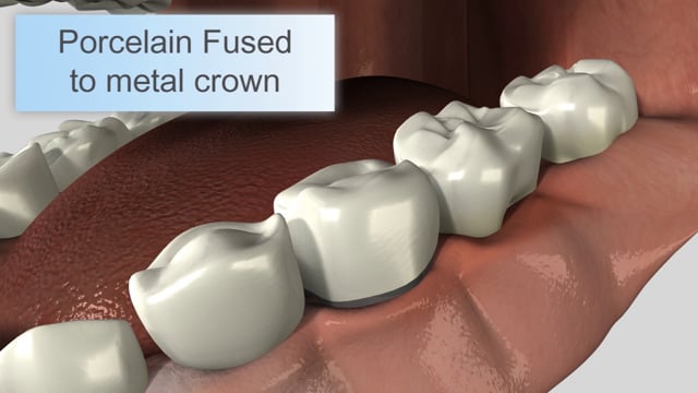 Types of Crowns
