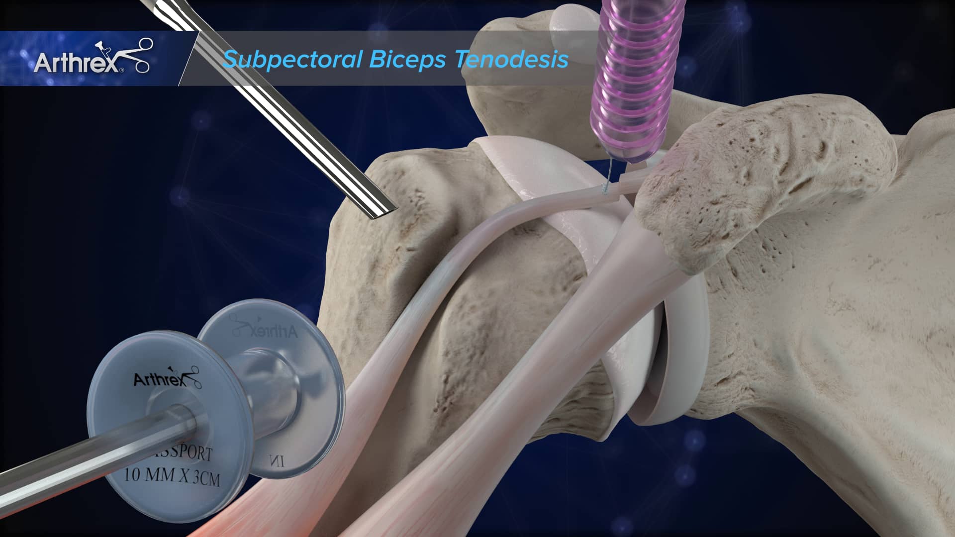 Subpectoral Biceps Tenodesis on Vimeo