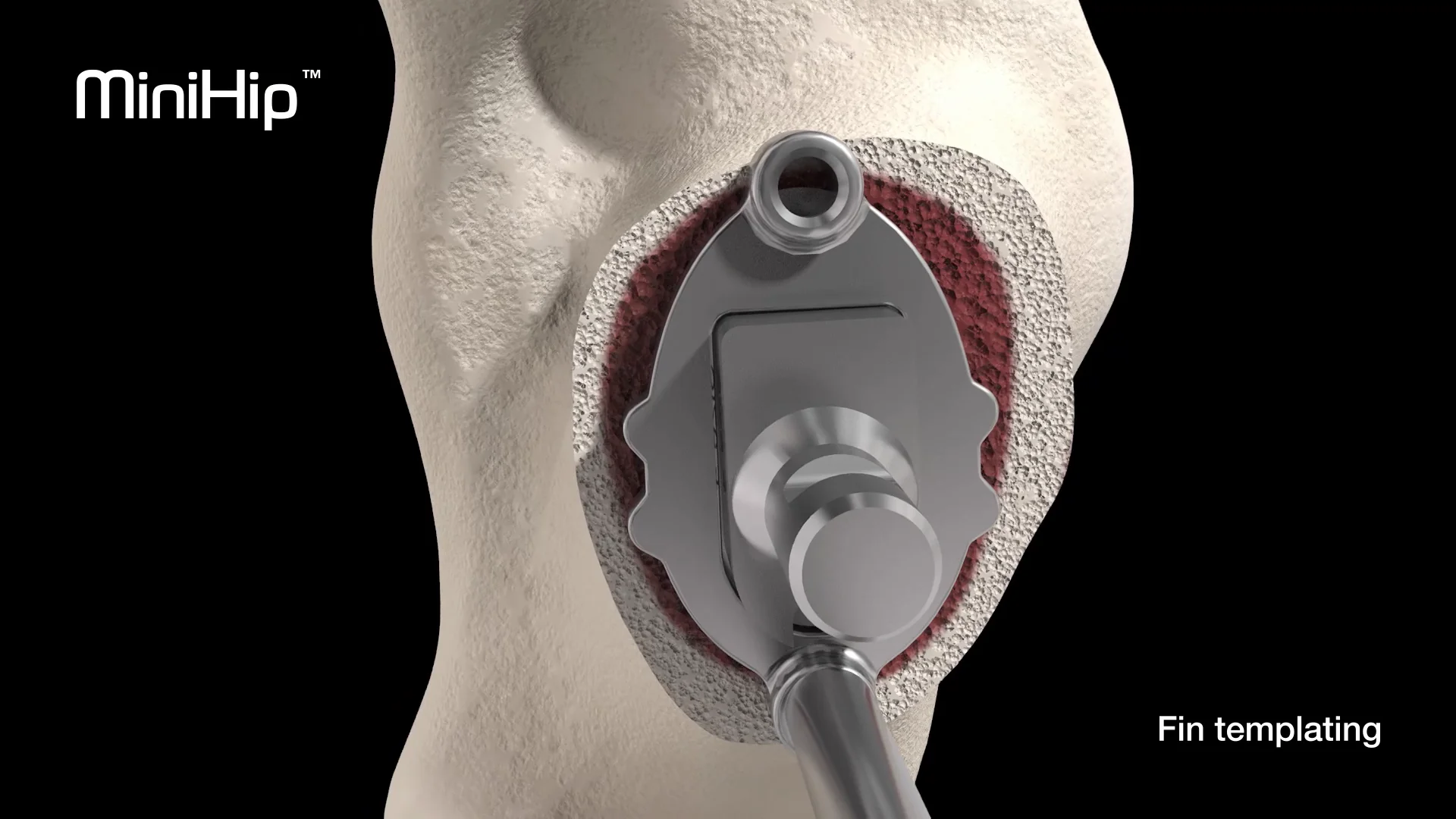 MiniHip™ - Surgical Technique (MKII Instrumentation)
