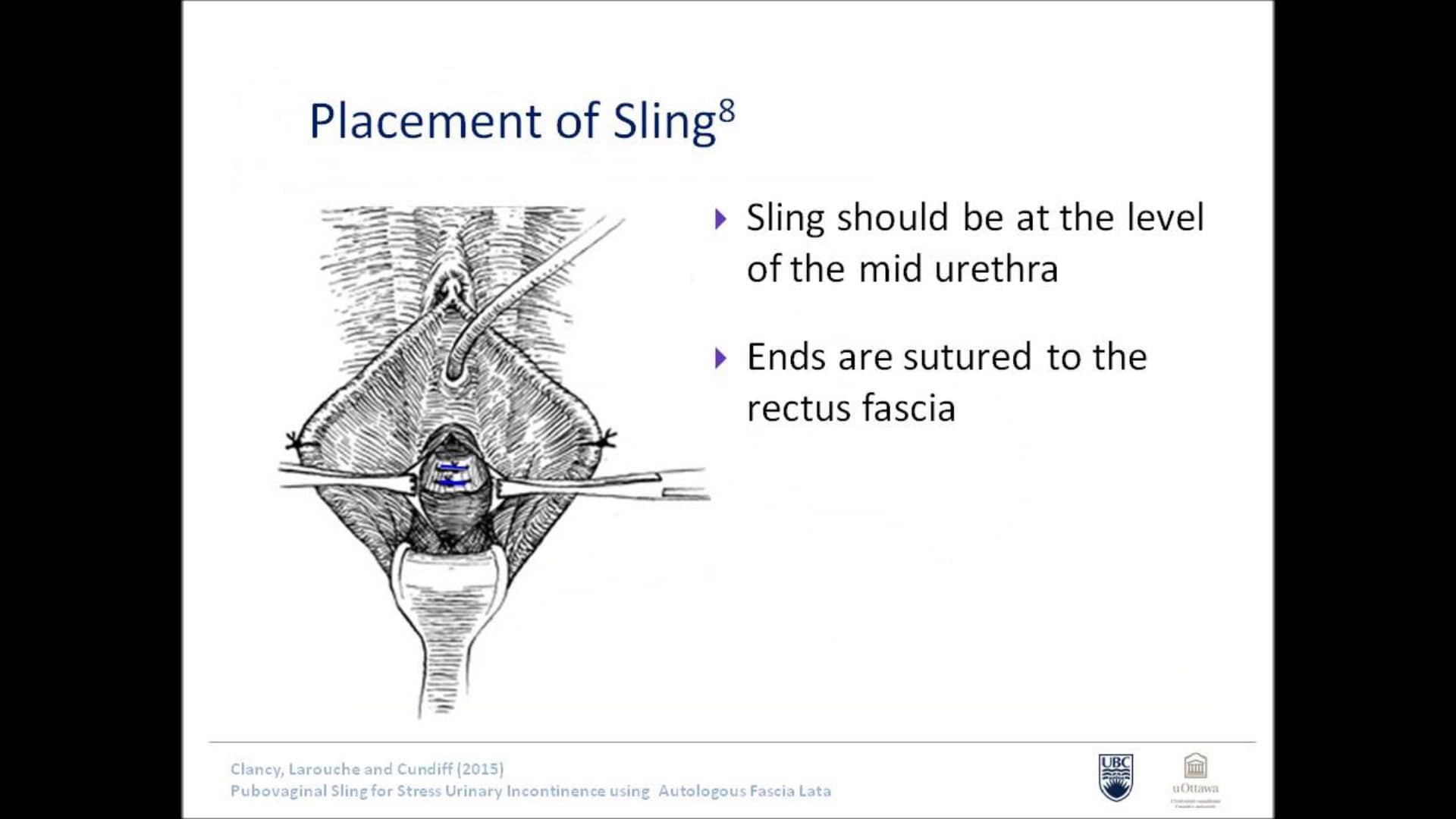 Video Presentation 03 PUBOVAGINAL SLING FOR STRESS URINARY INCONTINENCE