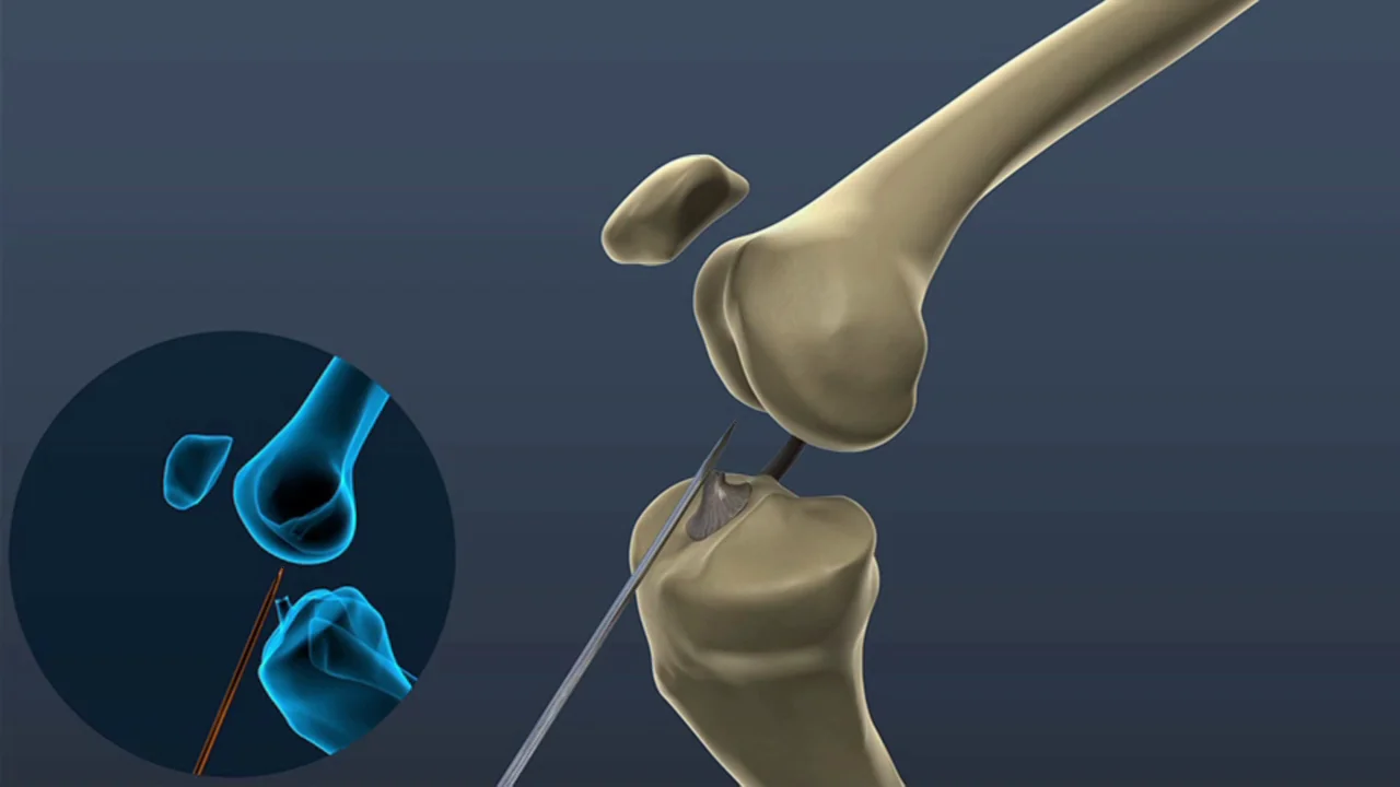 LARS™ ACL - Surgical Technique
