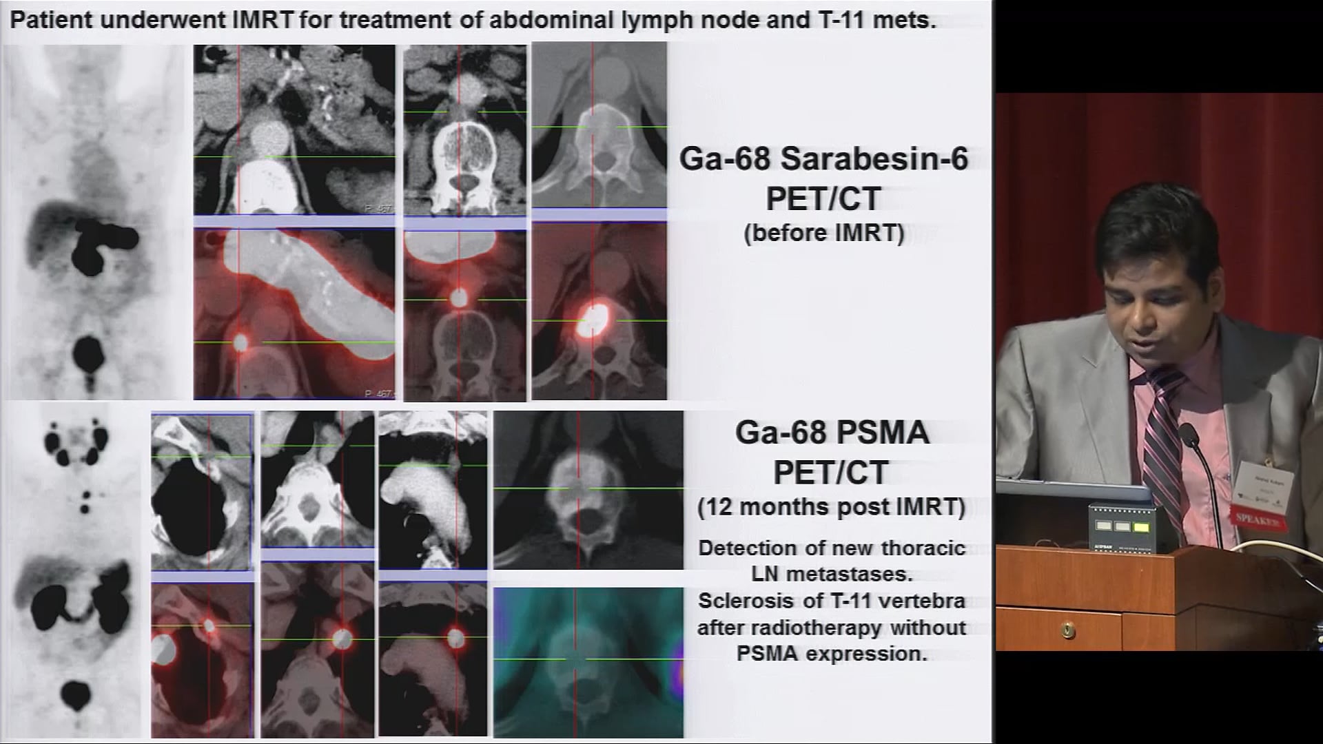 2.30 Role of 68Ga PSMA PET/CT is Recurring and Metastatic Prostate ...