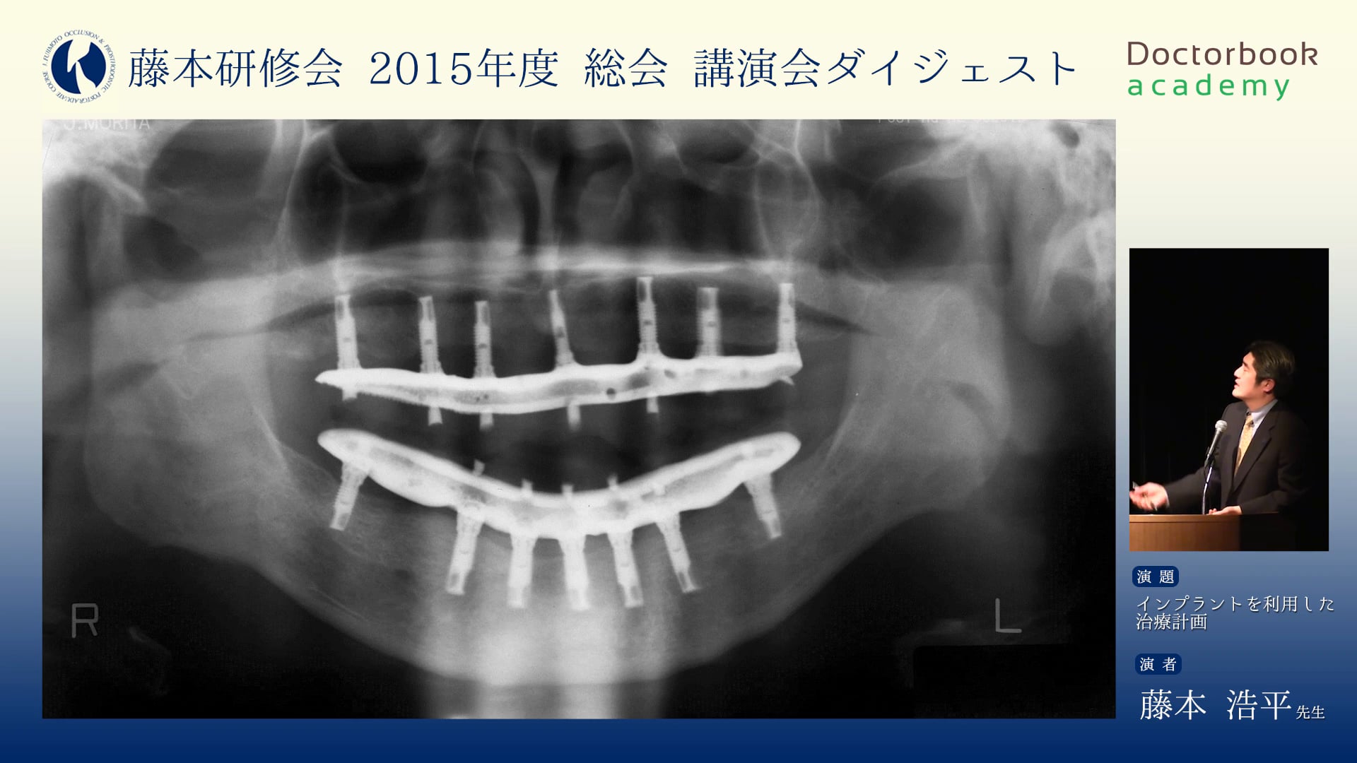 #1 ”Anterior Guidance”と審美/インプラントを利用した治療計画