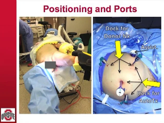 Port Placement for Robotic Renal Surgery