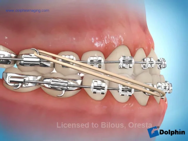 Does Everyone Who Wears Braces Need Elastics? - Soleil Orthodontics