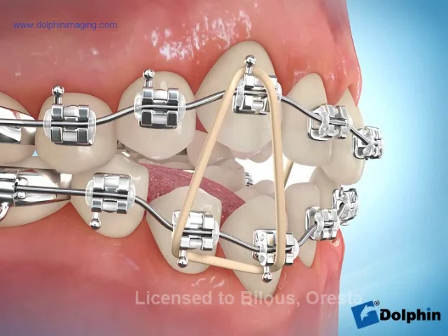 Triangle braces on sale for teeth