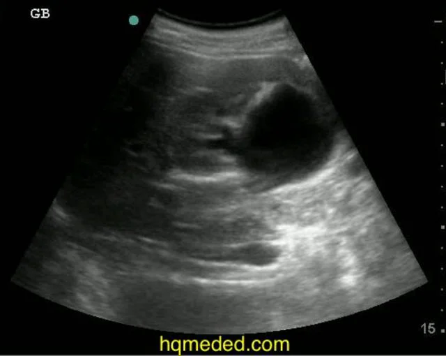 Ultrasonography - Bilateral Hydronephrosis in pregnancy on Vimeo