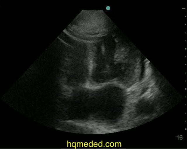 Ultrasonography - CHF, COPD On Vimeo