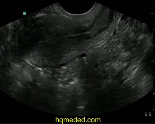 Ultrasonography - pelvic ultrasound on Vimeo