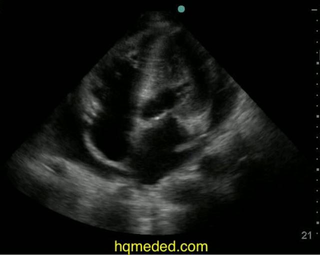 Ultrasonography - Pericardial Effusion, Early Tamponade On Vimeo