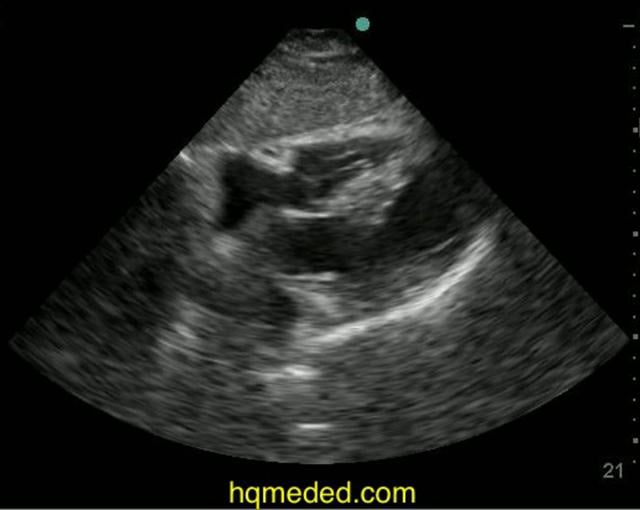 ultrasonography-poor-lv-function-on-vimeo