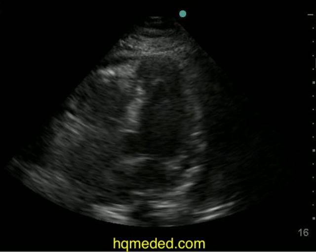 Ultrasonography small free fluid in posterior cul de sac on Vimeo