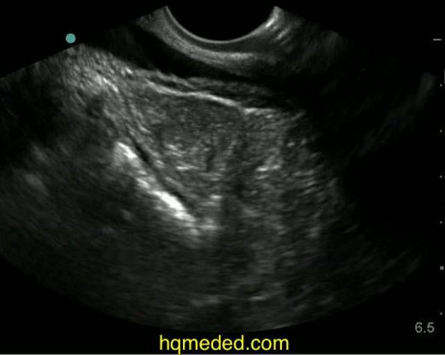 Ultrasonography - involuted corpus lutem on Vimeo