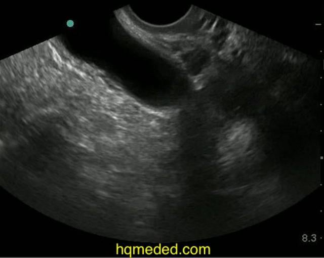 small free fluid in posterior cul de sac on Vimeo