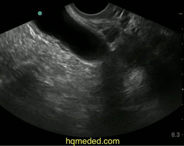 What Is Another Name For Posterior Cul De Sac