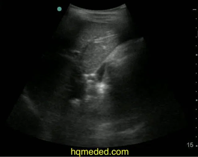 Ultrasonography small free fluid in pelvis on Vimeo