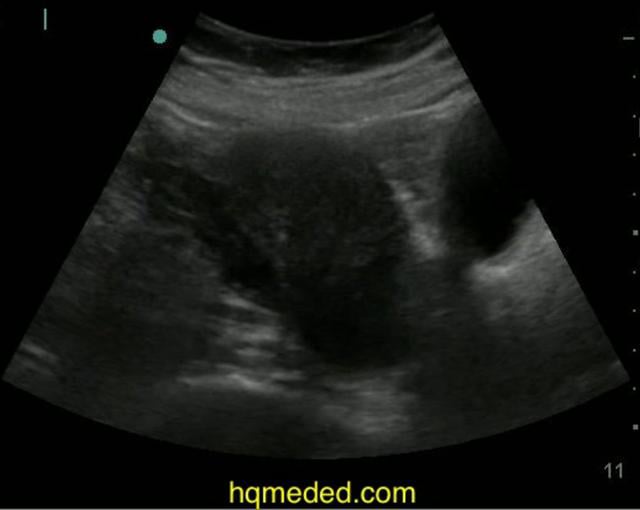 Ultrasonography - ruptured ectopic pregnancy on Vimeo