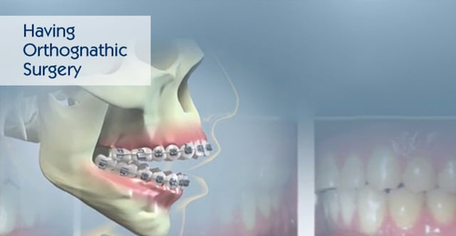 Having Orthognathic Surgery