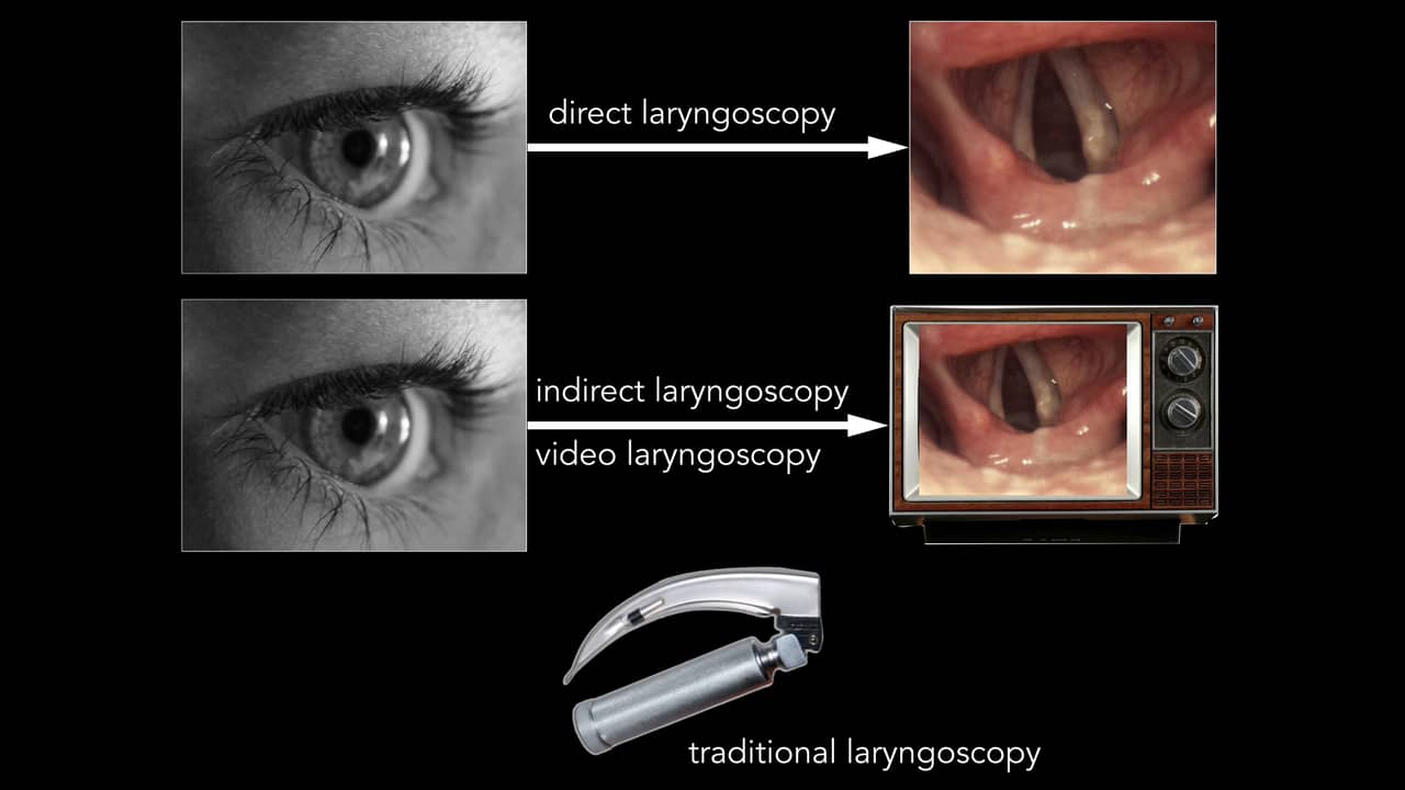 Direct vs. Video Laryngoscopy in 10 Minutes on Vimeo