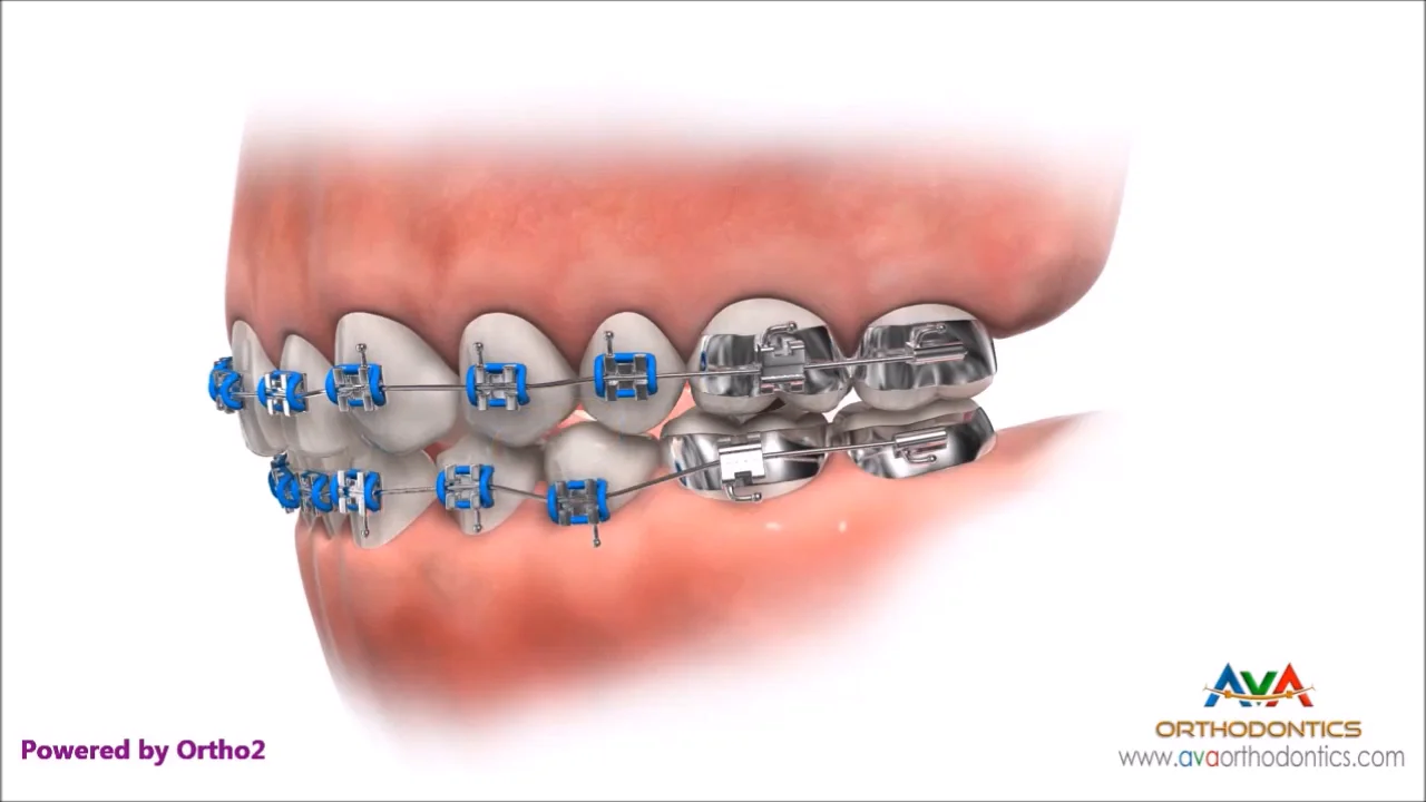 What Role do Elastics (Rubber Bands) Play in Orthodontics? - Gire