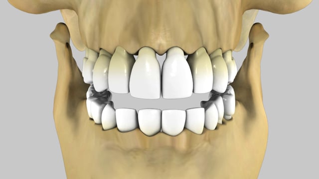 Anterior Cross Bite