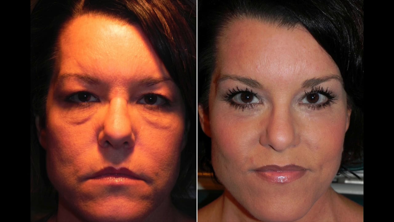 Episode 12 Is there a natural remedy for Malar Mounds and Eyelid