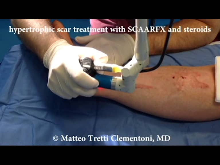 hypertrophic scar treatment with SCAARFX and steroids on Vimeo
