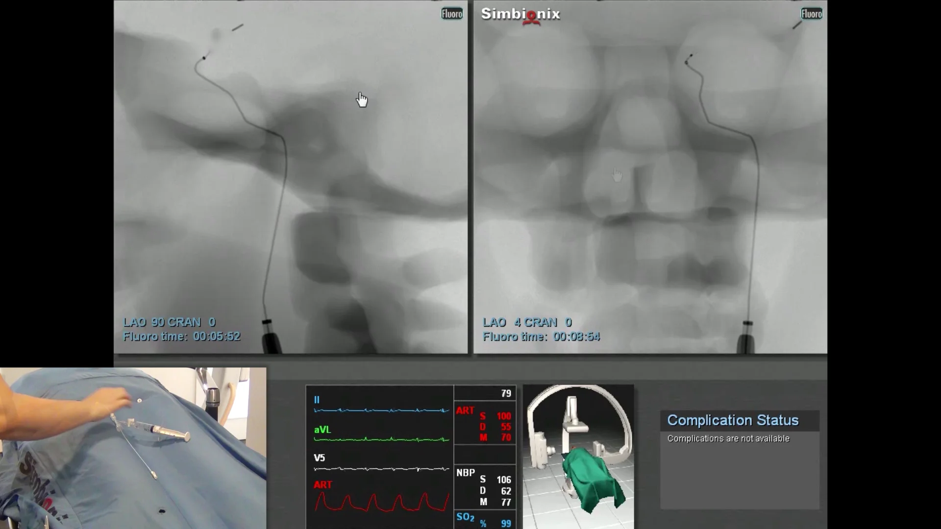 Acute Ischemic Stroke Intervention simulation case on ANGIO Mentor – No ...