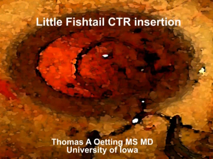 Little-Fish-Tail-CTR-Insertion