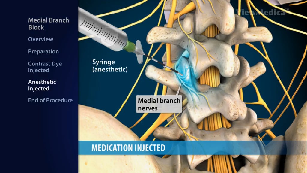 medial-branch-block-kypainassociates-on-vimeo