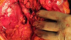 NEFRECTOMÍA RADICAL DERECHA CON RESECCIÓN DE TROMBO TUMORAL EN VENA CAVA INFERIOR NIVEL III
