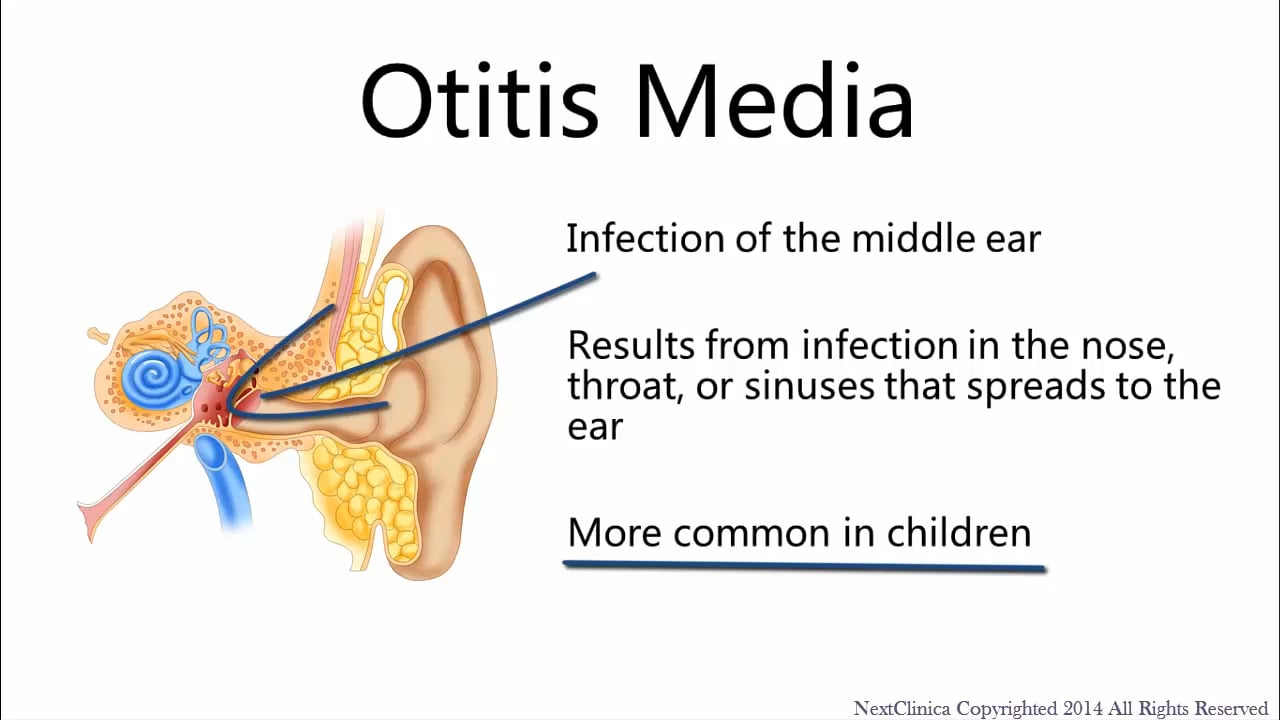 Otitis media adult with antibiotics on Vimeo