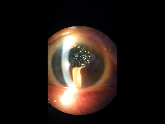 Asteroid hyalosis - Retina Image Bank