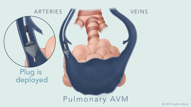 Embolization of Pulmonary Arteriovenous Malformations on Vimeo