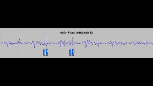 kyle-008-asd-fixed-split-s2-with-systolic-ejection-murmur-on-vimeo