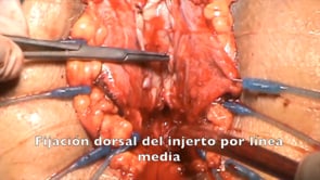 ESTRECHEZ DE URETRA BULBOPENEANA DE 16 CENTIMETROS, ¿ES POSIBLE RESOLVERLA EN UN SÓLO TIEMPO?
