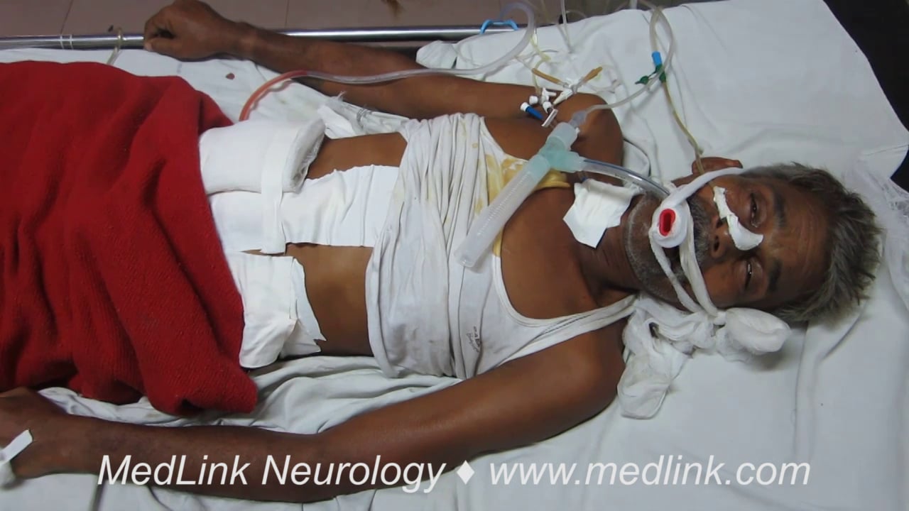 Post-anoxic myoclonus