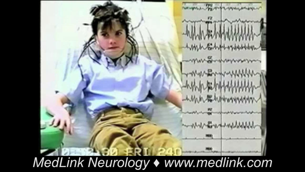 Focal hemifacial clonic seizures of rolandic epilepsy
