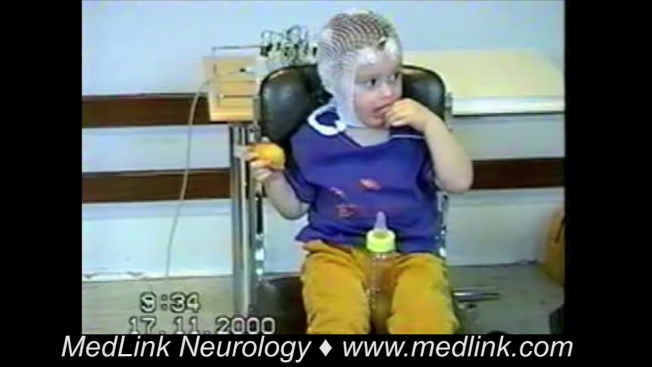 Myoclonic epilepsy in infancy