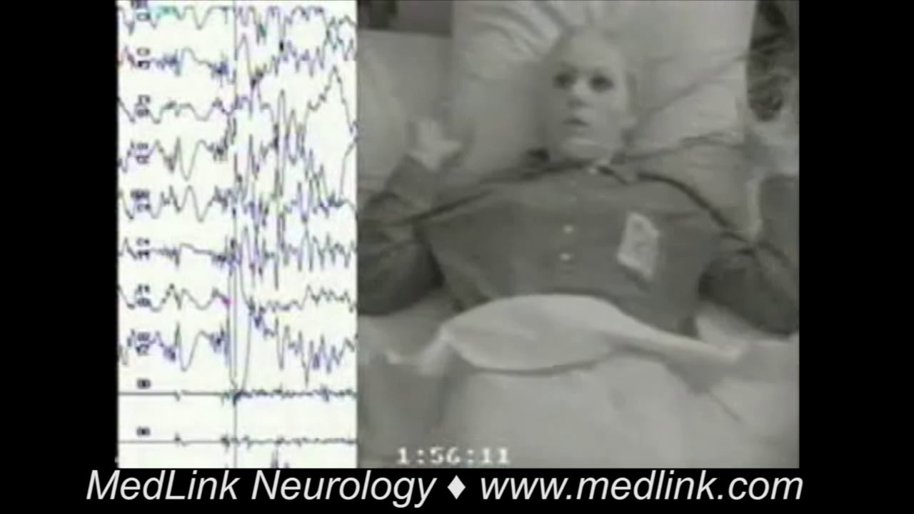 Myoclonic status epilepticus progressing to generalized clonic-tonic-clonic seizure in juvenile myoclonic epilepsy