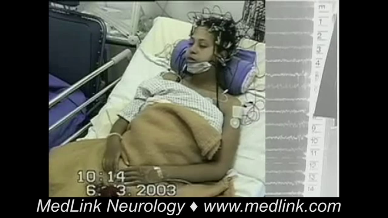 Progressive myoclonic epilepsy type 1 (EPM1): clinical manifestations