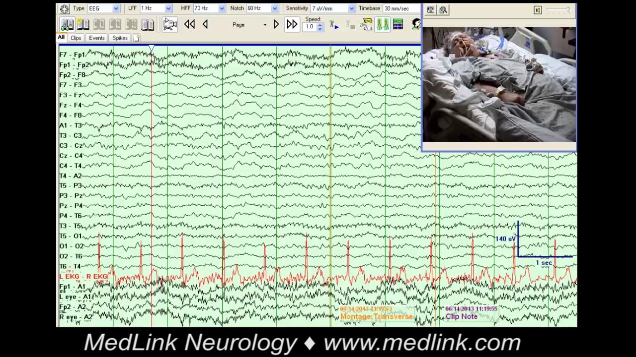 Simple partial seizure without EEG changes