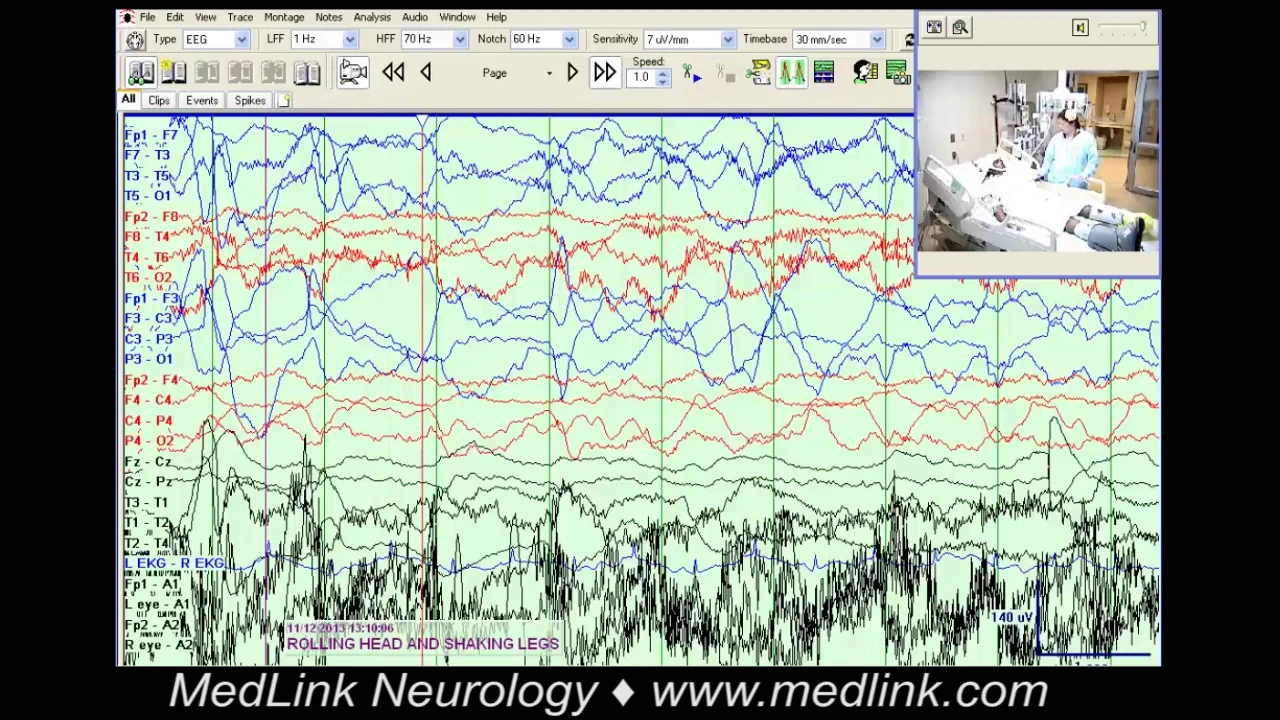Ambiguous paroxysmal events: posturing | MedLink Neurology