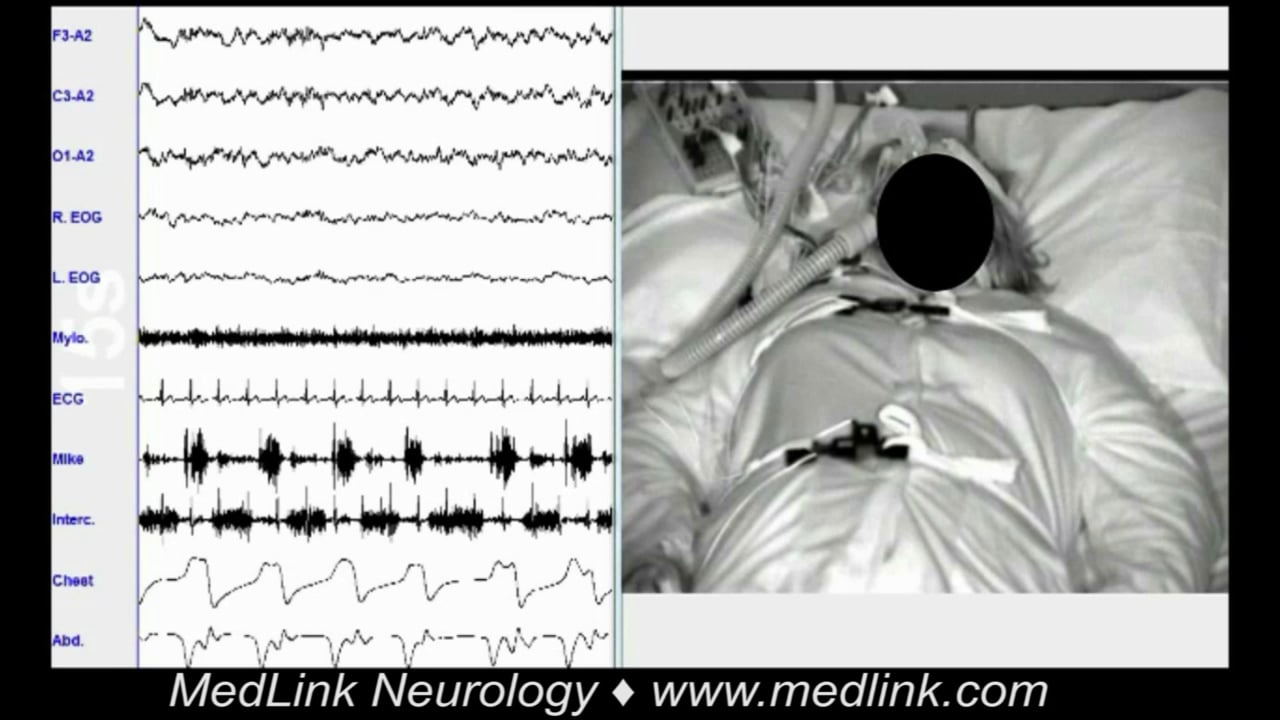 Sleeprelated laryngospasm MedLink Neurology