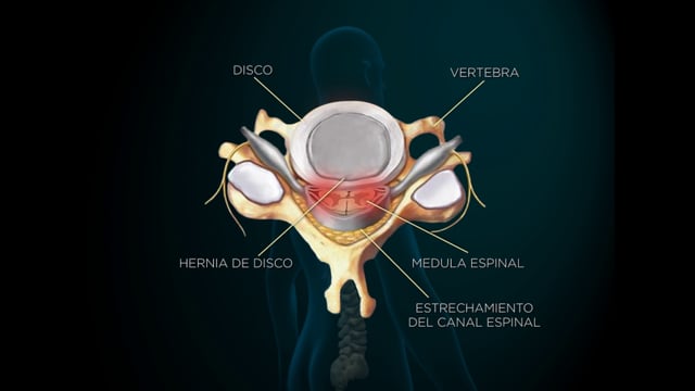 B1c Laminectomía Cervical