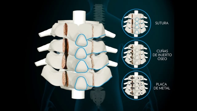 B1b Laminoplastía Cervical