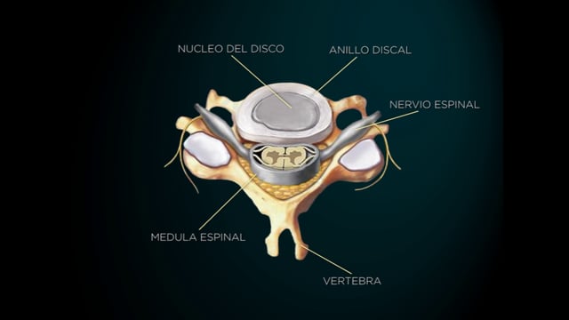 Hernia Discal Cervical
